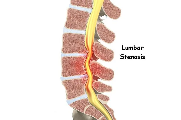 Lumbar Stenosis 