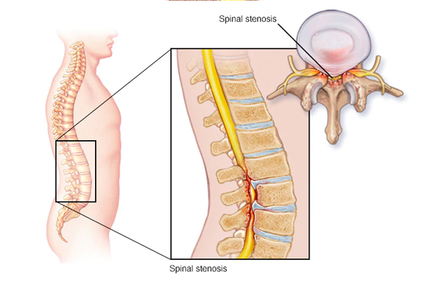Spinal Canal Stenosis 