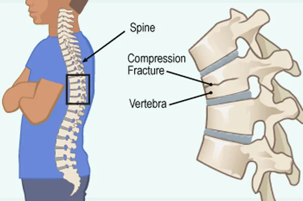 Spine Fracture