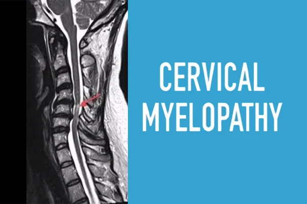Cervical Myelopathy